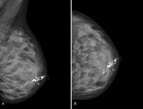 Chụp X-quang vú có thuốc cản quang