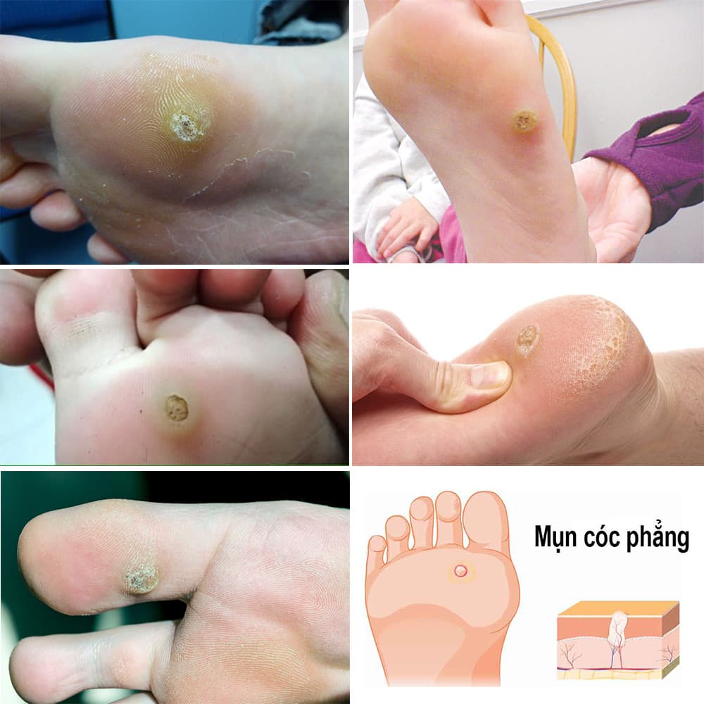 Miếng đệm loại bỏ mụn cóc Dr. Scholl’s Clear Away Wart Remover Plantar 24 miếng