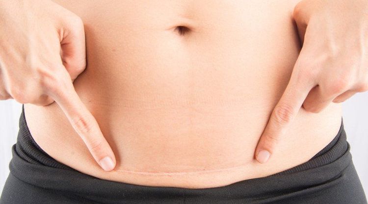 Tỷ lệ sinh mổ ở phụ nữ trên 40 tuổi thường cao hơn.