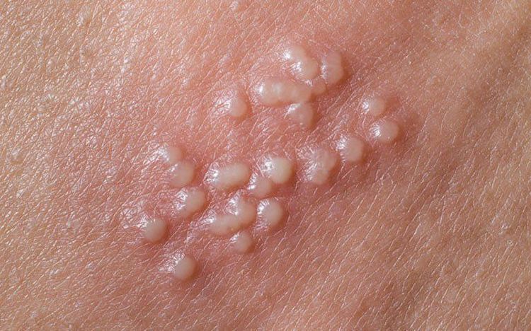 Herpes sinh dục: Hình ảnh, Triệu chứng và Điều trị