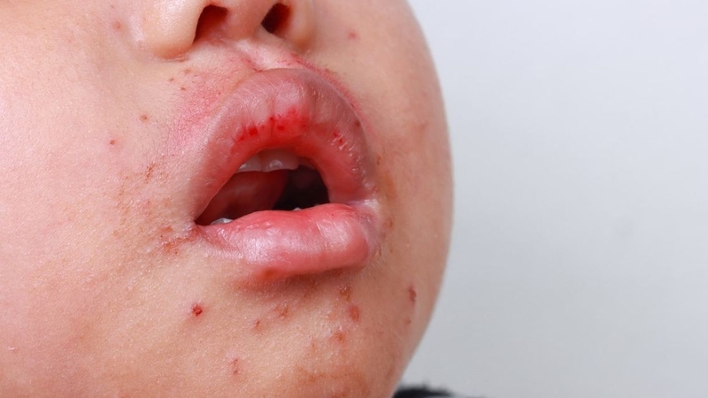 Cần theo dõi sát triệu chứng tay chân miệng độ 3 ở trẻ
