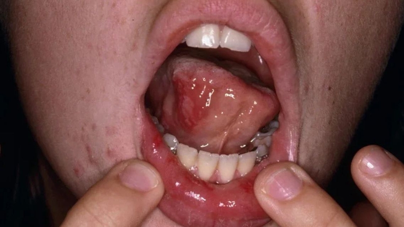 Hình ảnh bệnh tay chân miệng cấp độ 3: Cảnh báo biến chứng nguy hiểm