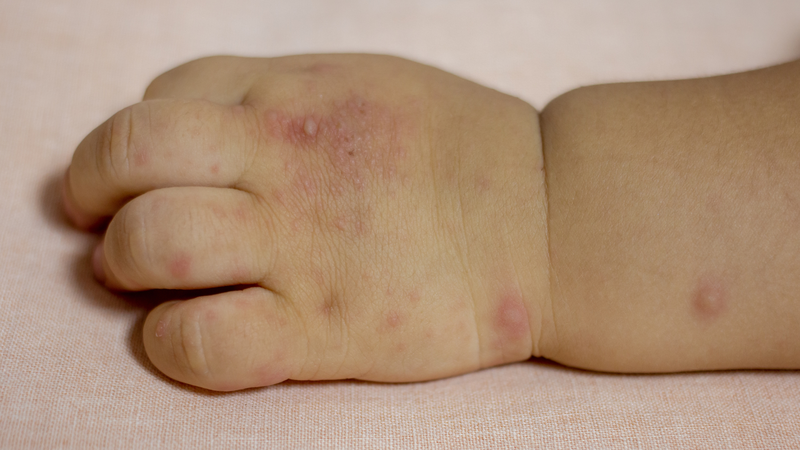 Trẻ bị tay chân miệng cấp độ 3 có thể gặp triệu chứng ở mức độ khác nhau