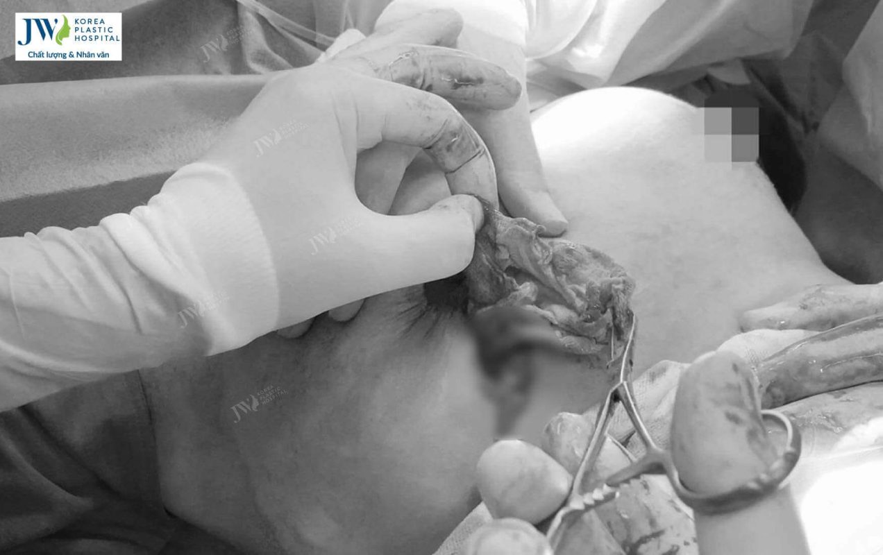 Nâng ngực có nguy hiểm không? Làm gì để hạn chế rủi ro?