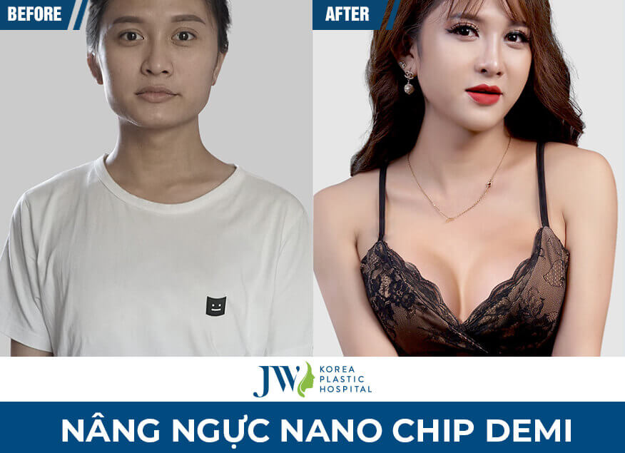 nang-nguc-golden-line