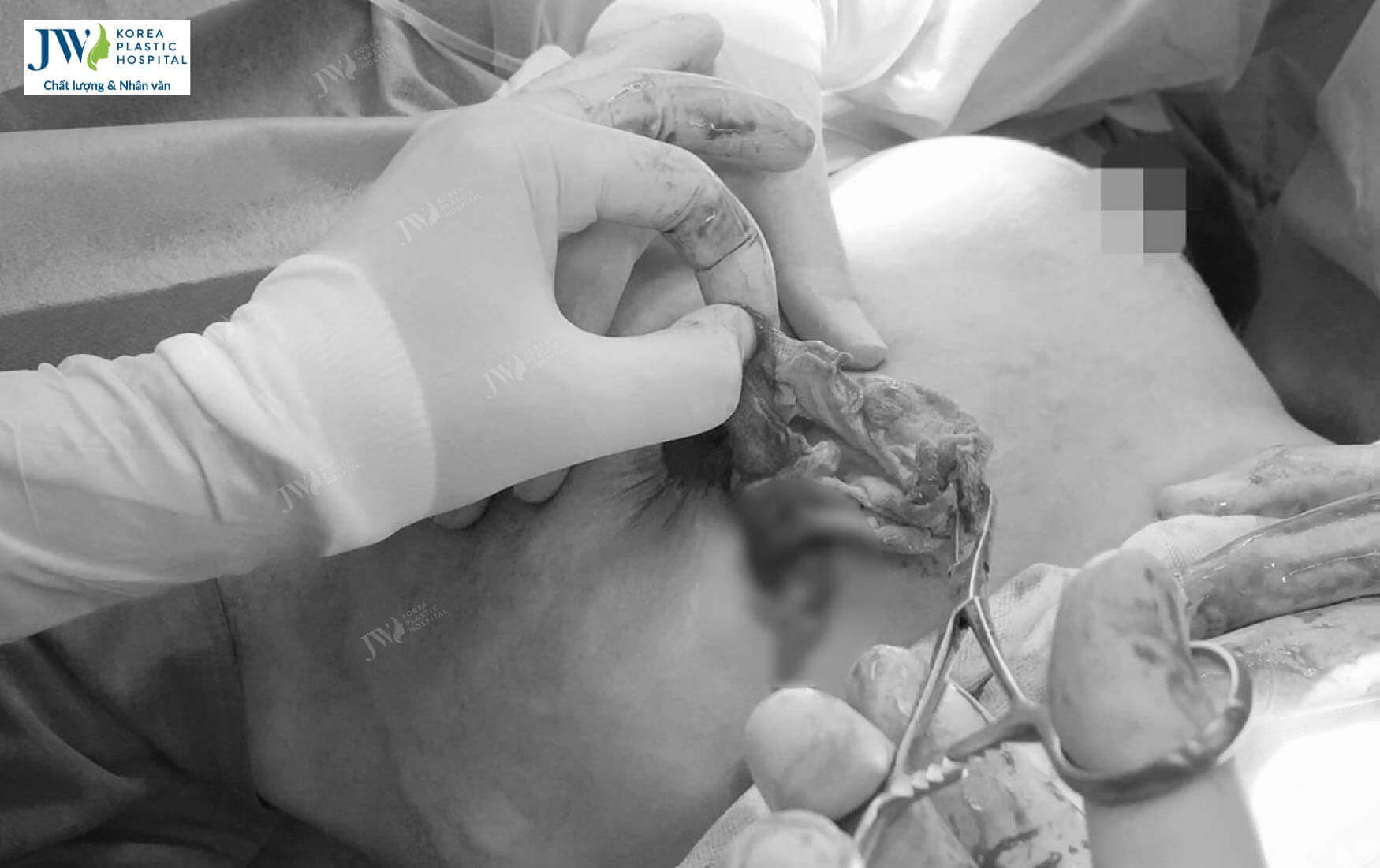 nguy-hiem-khi-nang-nguc