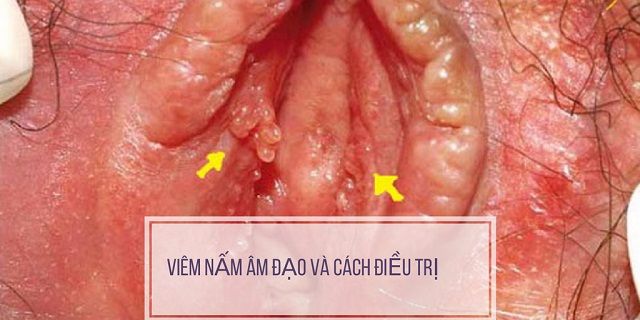 Hình ảnh sùi mào gà ở âm đạo