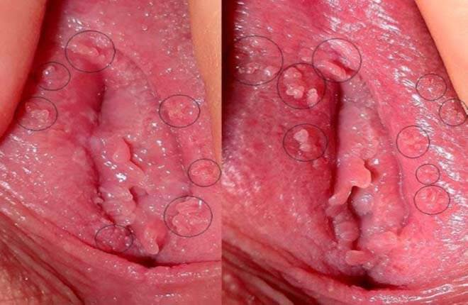 10 Hình ảnh mụn gai sinh dục nữ giới cạnh vùng kín chi tiết