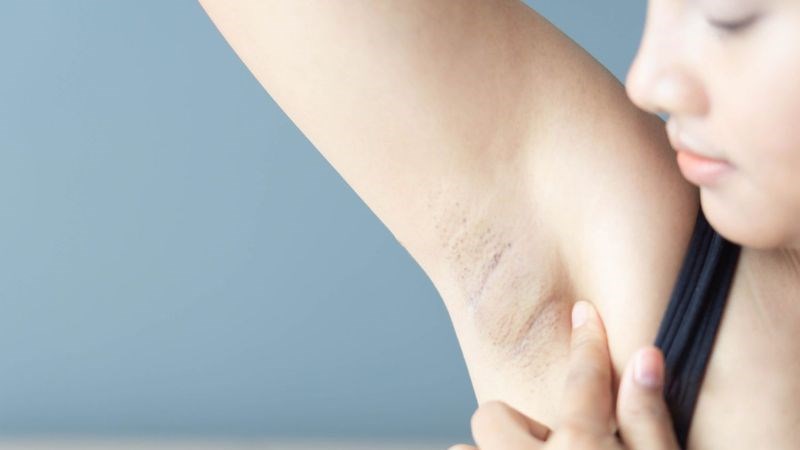 Trẻ bắt đầu mọc lông tại nách
