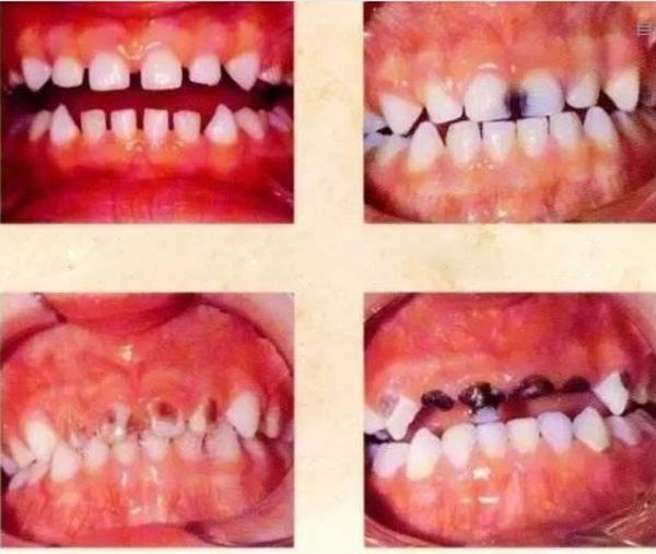 Bé 1 tuổi sâu mòn răng vì thói quen nhiều mẹ Việt hay làm trước giờ đi ngủ của con - 2