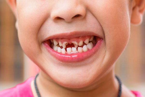 Bé 1 tuổi sâu mòn răng vì thói quen nhiều mẹ Việt hay làm trước giờ đi ngủ của con - 4
