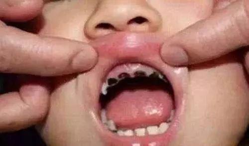 Bé 1 tuổi sâu mòn răng vì thói quen nhiều mẹ Việt hay làm trước giờ đi ngủ của con