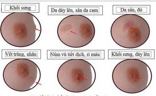 Chẩn đoán hình ảnh trong tầm soát ung thư vú