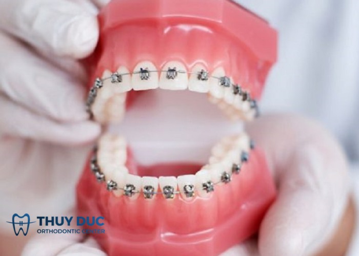Niềng răng có giúp sở hữu gương mặt trái xoan? 1