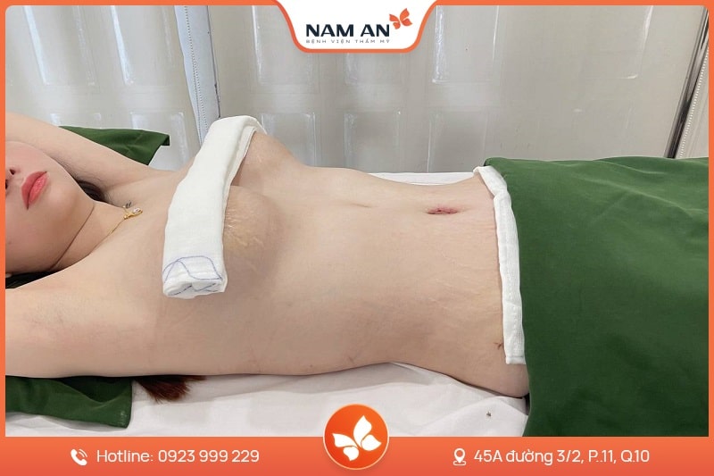 Thu Gọn Quầng Vú Tỉ Lệ Vàng, Không Lộ Sẹo Tại Nam An (5)