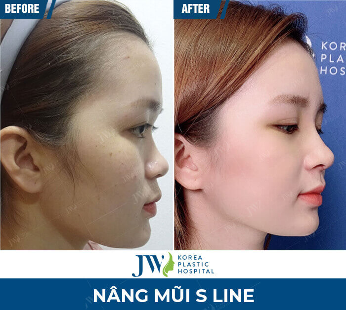 vi sao ban nen nang mui s line