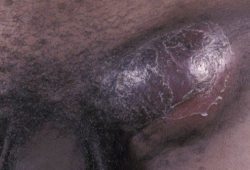 Bệnh hột xoài là một bệnh lây truyền qua đường tình dục do một chủng vi khuẩn Chlamydia trachomatis hiếm gặp gây ra.
