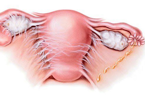 Đau bụng dưới, sốt, đau khi quan hệ tình dục hoặc khi đi tiểu là những triệu chứng của bệnh viêm vùng chậu
