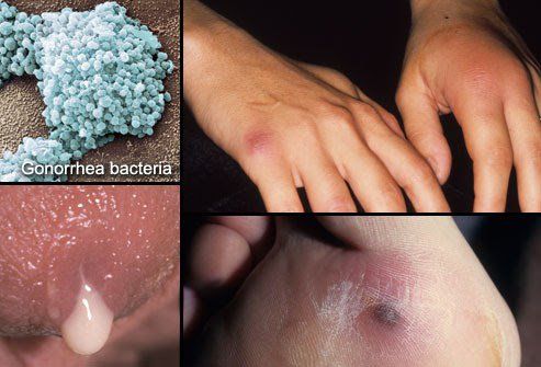 Bệnh lậu do vi khuẩn Neisseria gonorrhoeae.