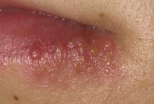 Virus herpes simplex 1 gây bệnh herpes