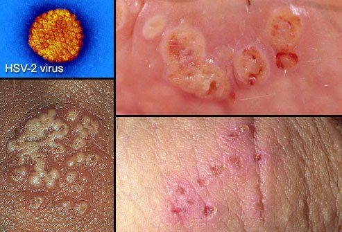 Mụn rộp sinh dục chủ yếu do virus Herpes simplex type 2 (HSV-2) gây ra