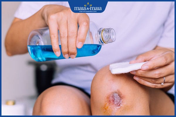 vệ sinh vết thương hở